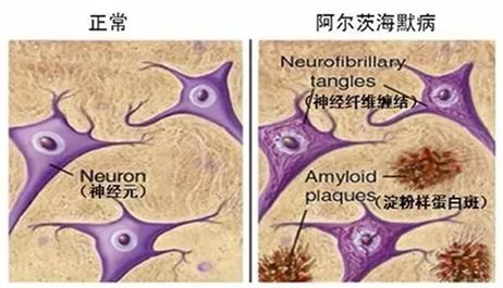 “探索飞蚊症最新疗法”